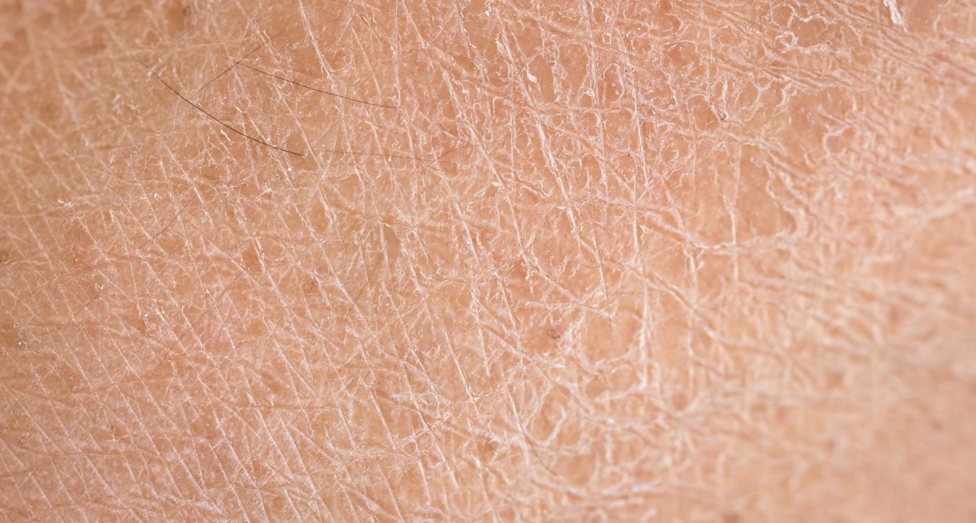 Close-up de pele ressecada na menopausa, mostrando textura áspera, linhas finas e descamação da pele.