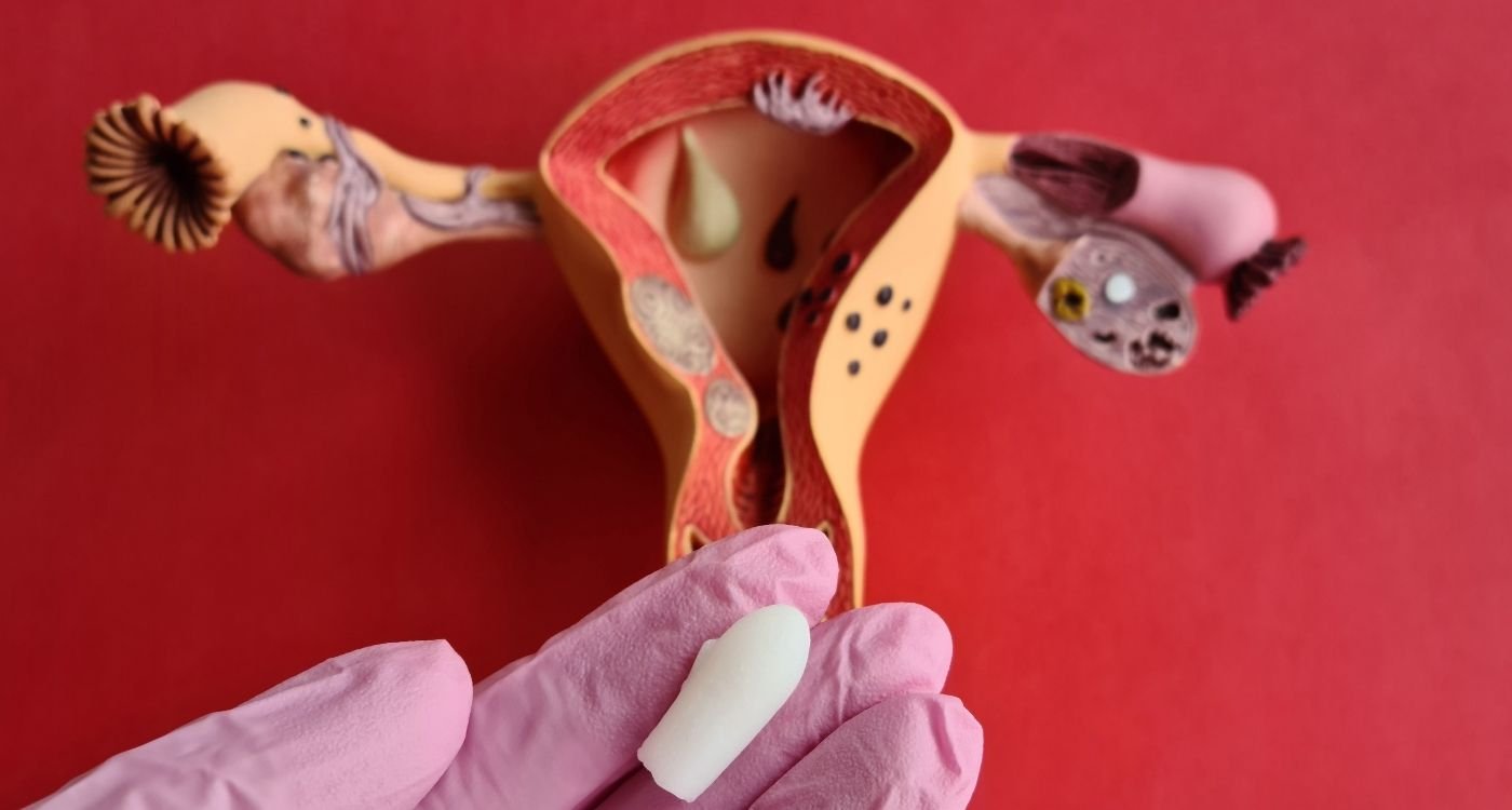 Mão com luva segurando óvulo vaginal, com modelo anatômico do útero ao fundo, ilustrando tratamento da secura vaginal na menopausa.