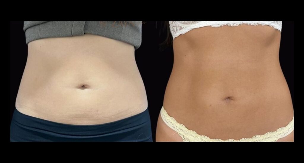 antes e depois de tratamento de estética no pós emagrecimento