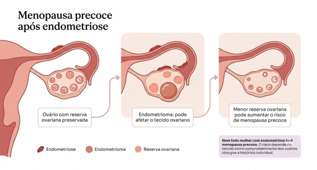Ilustração educativa dos ovários explicando menopausa precoce após endometriose, endometriomas e reserva ovariana.